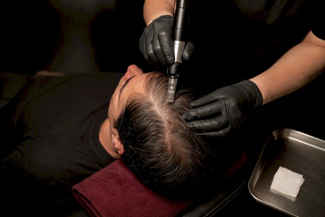 Scalp Microneedling for Men: Expect Density Gains by 12–16 Weeks