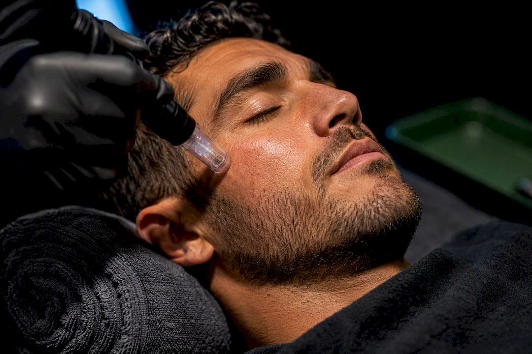 3–6 Sessions to Shrink Men's Pores with Clinician Led Microneedling