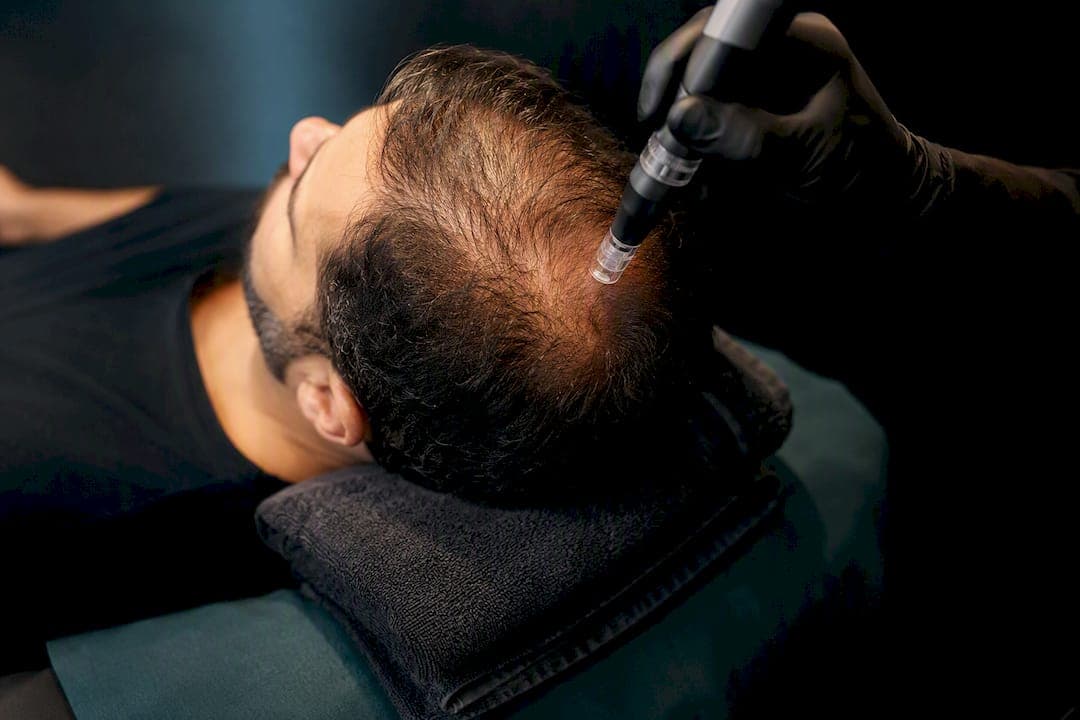 Clinic Evidence: Microneedling Boosts Minoxidil Results in 12–16 Weeks