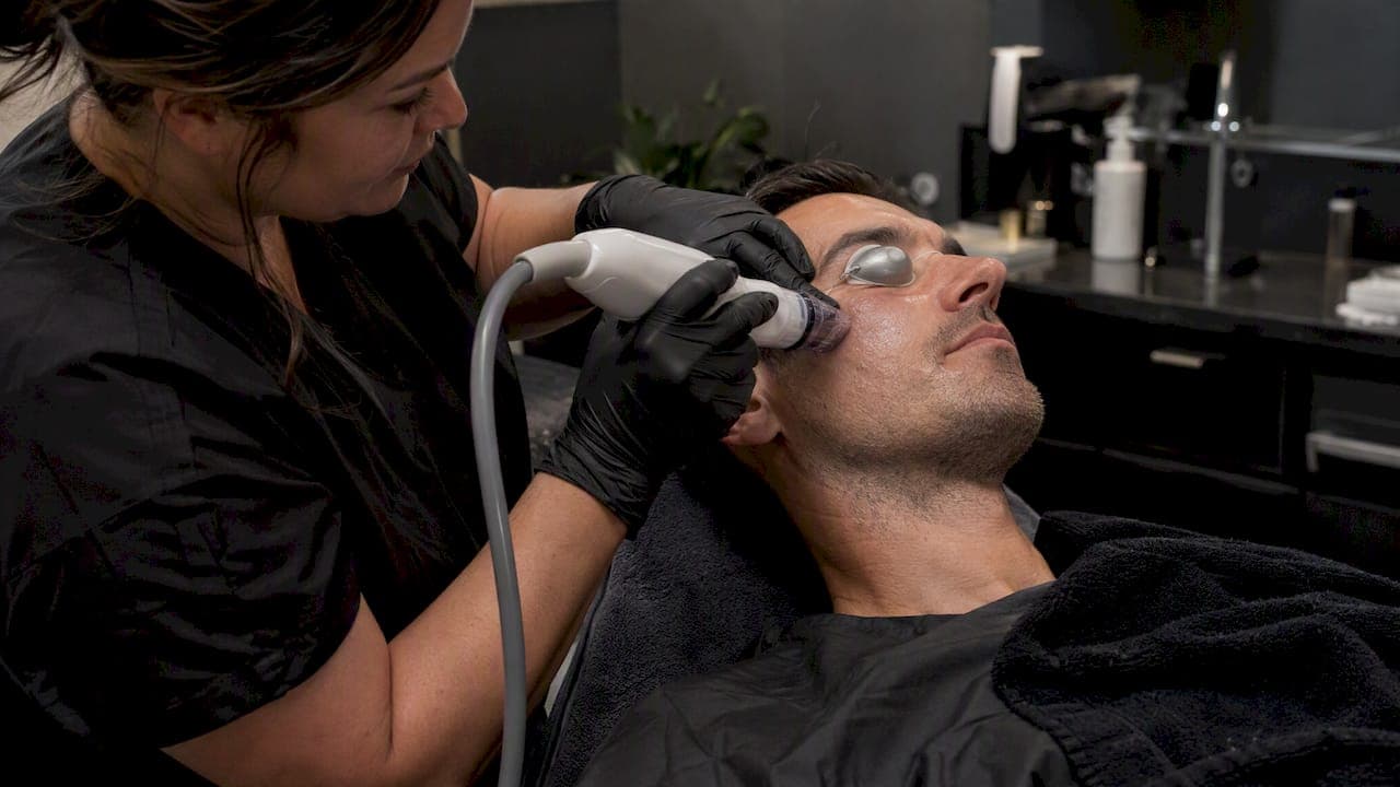 Microneedling Under the Eyes: What Works for Men
